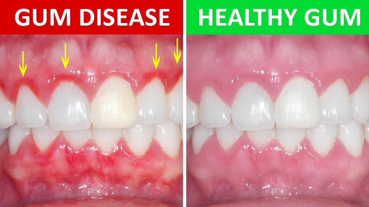 Gingivitis Gum Disease Know Everything About It