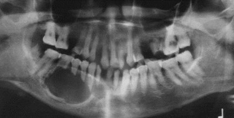 Ameloblastoma in the right side of the jaw