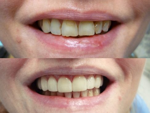 After placement of veneers