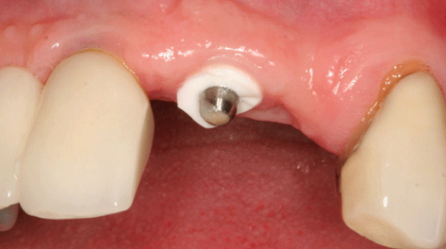 Fracture of restorative material of a dental implant