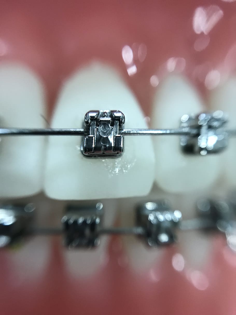 ideal age for dental braces