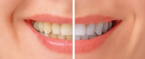 teeth-whitening-myths-best-practices