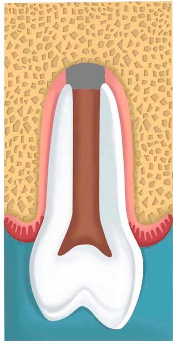 Anatomical diagram of an immature tooth with an open apex, What is the Apexification Procedure?