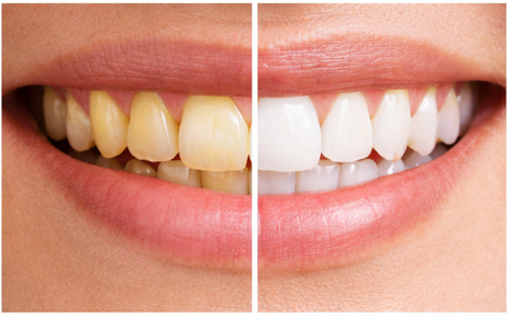 yellow teeth vs white teeth comparison